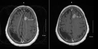 Image result for Brain Lesion
