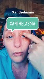 Dr Lisa Weideman Xanthelasma