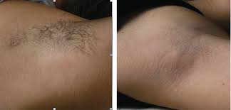 Don't miss out on fantastic daily cork tattoo removal vouchers. Tattoo Removal Cork Tattoo Design