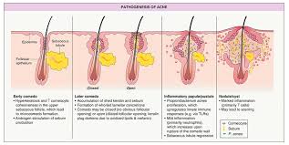 Keratin is a protein that lines the hair follicles. Pharmaceutics Free Full Text Targeted Topical Delivery Of Retinoids In The Management Of Acne Vulgaris Current Formulations And Novel Delivery Systems Html