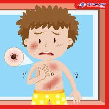 Image result for scabies human children