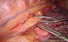Early detection of complications is critical to improve patient outcomes after esophagectomy. Esophagectomy Three Field Mckeown Laparotomy And Right Thoracoscopy Thoracotomy With Cervical Anastomosis Iowa Head And Neck Protocols