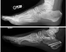 Image result for Calcaneus