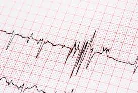 How does an abnormal ecg effect a patient's preoperative evaluation? Abnormal Ecg Results Causes And Treatment Heart Care In Nairobi
