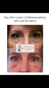 Lower Lid Blepharoplasty: Post-Op Results and Care