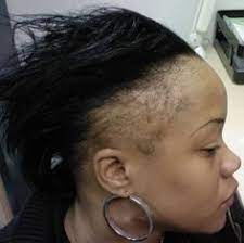 Regrowing Thin Edges And Bald Spots Caused By Alopecia With Essential Oils Black Women Hair Loss Bald Spot Treatment Alopecia Treatment