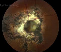 Image result for Coloboma