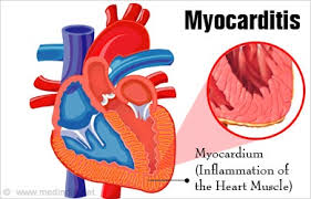 Learn more about myocarditis or inflammation of heart muscles, possible causes, symptoms, treatment, personal experiences. Asics Frontrunner What Runners Should Know About Myocarditis