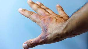 Sometimes an infection may occur even with. Burns Types Symptoms And Treatments