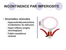 Le dr géraud répond à cette question posée lors du chat sur le page facebook de l'afu organisé pour la semaine de la continence 2018. L Incontinence Urinaire Ppt Video Online Telecharger