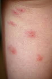 How do chigger bites work. How To Prevent And Treat Chigger Bites Lady Lee S Home