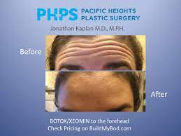 How long for botox to work in forehead. How Long Does It Take Botox And Fillers To Work Video Buildmybod Health
