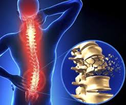 Image result for Spinal Trauma