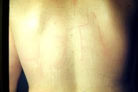 Image result for Dermatographism