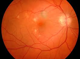 Histoplasmosis Louisville Ky Eye Surgery Florence