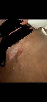 Check if you have ingrown hair. Ingrown Hair By Genitals Help Other Conditions And General Health Forums Patient