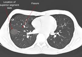 Pneumothorax is defined as the presence of air or gas in the pleural cavity (ie, the potential space between the visceral and parietal pleura of sections pneumothorax. Thoracoscopic Management Of Spontaneous Pneumothorax Ctsnet