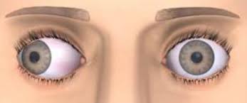 Ophthalmology Exotropia Dr Maria Elisa Scarale