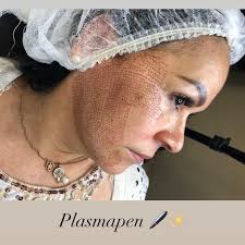 Plasmapen 🖊✨ Rejuvenecimiento Facial sin cirugía 🧏🏻‍♀️🙋🏻‍♀️🙋🏻‍♂️✨  #plasmapen #plasmapentreatment #plasmalift 📍Vinces • Guayaquil @ Centro  Estético Ingrid Ching