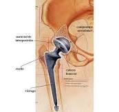 Biomateriales para el par articular de las prótesis de ...