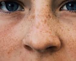 More definitions, origin and scrabble points Nose What Is It Symptoms Causes Prevention And Treatment Top Doctors