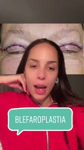 Mañana me hago la blefaroplastia 🔥🔥 #operacionfacial #medicinaestetica  #parati #viral #blefaroplastica
