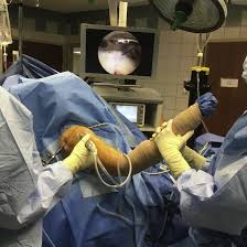 Arthroscopic Identification Of Partial Thickness Rotator Cuff Tears Arthroscopy Techniques
