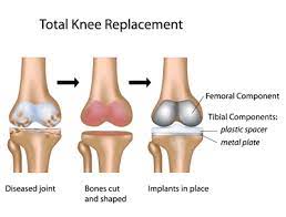 Knee Replacement Cost In India With Indicure