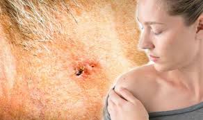 Learn about the academy's efforts to refocus its brand on education. Skin Cancer Open Sore That Doesn T Heal Is A Symptom Of The Disease Express Co Uk