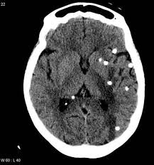 Neurocysticercosis Ncc Is Caused By Cns Infection With The Pork Tapeworm Taenia Solium Infection Which Leads To Extra In Radiology Eat Food Parasitic Worms