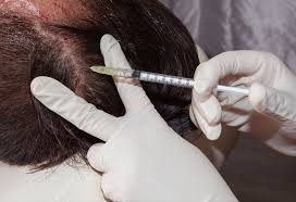 Cortisone works by reducing inflammation. How Is Alopecia Areata Treated