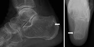 Image result for Calcaneus Compression Fracture