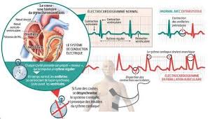 Elles peuvent être déclenchées par l'exercice, le stress émotionnel, la caféine et la nicotine. Troubles Du Rythme Quand Le Coeur Deraille