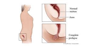 Image result for Rectal prolapse