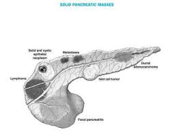 View In Full Resolution In 2020 Pancreatic Diagnosis Tumor