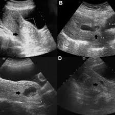 The black spaces on the baby's head are the brain. Transabdominal Ultrasound Images Showing A An 8 Week 1 Day Cervical Download Scientific Diagram
