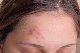 Tunggulah hingga jerawat tampak seperti benjolan keras dengan puncak yang berwarna putih. Beauty Journal Situs Kecantikan Dan Gaya Hidup Andalan Wanita Masa Kini