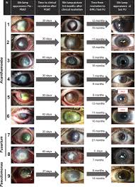 We did not find results for: Rose Bengal Photodynamic Antimicrobial Therapy For Patients With Progressive Infectious Keratitis A Pilot Clinical Study American Journal Of Ophthalmology