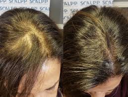 Styling fine hair can be quite a task. Scalp Micropigmentation For Women Thinning Hair Houston Texas Austin Texas