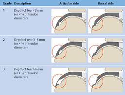 3.0% type ii curved (42.9%) angle of anterior page: Shoulder Joint Radiology Key