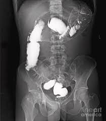 Image result for Intestinal Malrotation