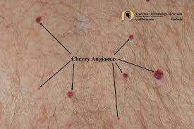 They are the most common kind of angioma, and increase with age, occurring in nearly all adults over 30 years. Cherry Angioma Senile Angioma Academic Dermatology Of Nevada