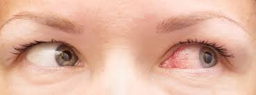 Derrame En El Ojo Causas Y Soluciones Canalsalud