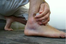 There are several major ligaments in the ankle: Third Degree Ankle Sprain Emergeortho