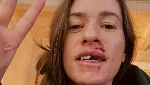 Fundraiser for Abigail Hunt by Alyssa Sena : Support Abigail's Dental  Recovery: Bring Back Her Smile