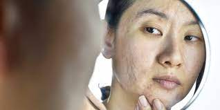Acne Holes On Face: Types, Treatment, Cost And Prevention Tips