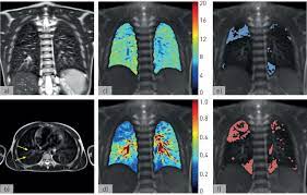 Unique to cystic fibrosis, seen in 20% of patients; Novel Magnetic Resonance Technique For Functional Imaging Of Cystic Fibrosis Lung Disease European Respiratory Society