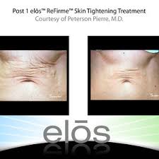 How do stretch marks look like? Rf Microneedling Stretch Mark Reduction Services Executive Skin Laser Palm Harbor