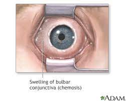 Chemosis Information Mount Sinai New York