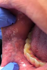 Image result for papillomavirus tongue)